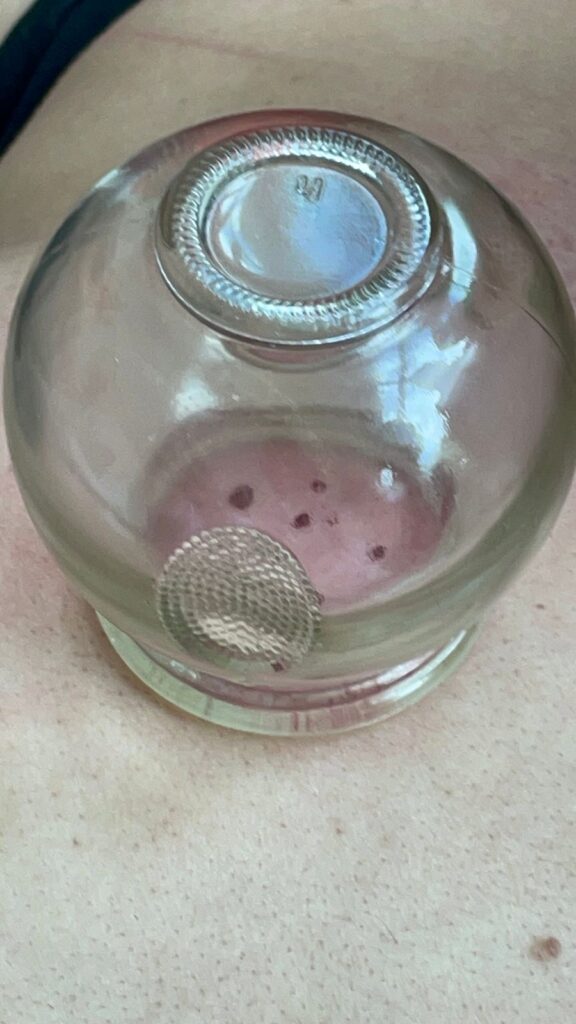 Ventosa de vidro fixa sobre os furinhos, puxando o sangue